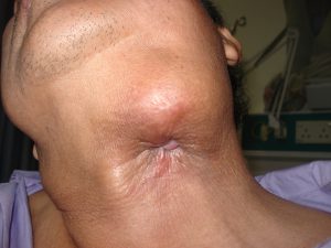 Left Submandibular Carcinoma