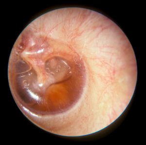 Left Middle Ear Effusion