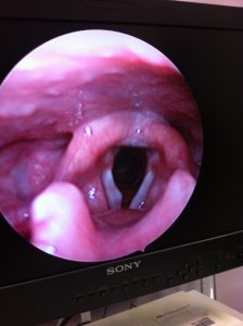 Right Vocal Cord Cyst