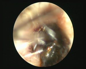 Cockroach in The Right Ear